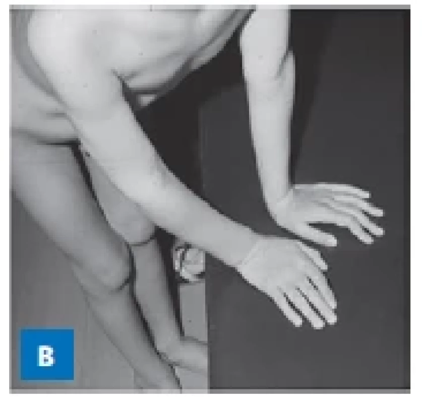 10letý chlapec s homocystinurií.
A – skolióza,
mírná deformita hrudníku,
genua valga s atypickou
konfigurací kolenních kloubů
v rámci metabolické osteopatie.
B – arachnodaktylie
u stejného chlapce.