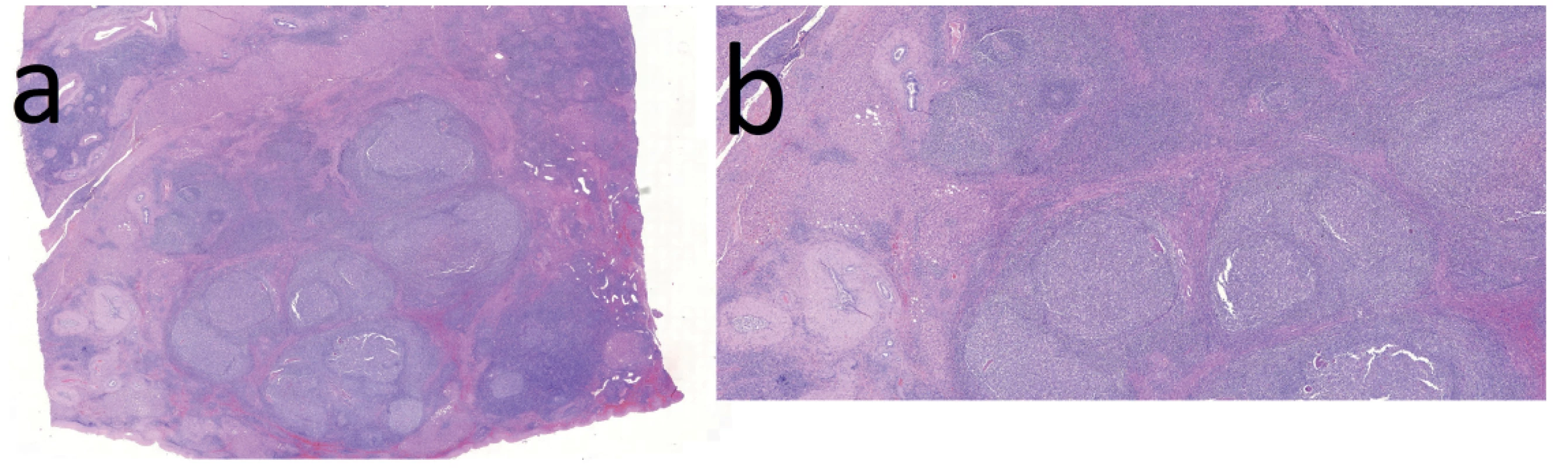 Histologické řezy v barvení Hematoxylin/Eosin: 4a − přehledné zvětšení (histotopogram). Většinu řezu zaujímá folikulární
lymfoidní hyperplazie, dále jsou patrny části jaterního parenchymu a proliferace cév a žlučovodů; 4b − při větším
zvětšení jsou patrny lymfoidní folikuly s objemnými zárodečnými centry a úzkými plášti, naznačená nodularita okolního
jaterního parenchymu se steatózou a zmnožené žlučovody<br>
Fig. 4. Histology cuts in Hematoxylin/Eosin staining: 4a − low magnification; follicular lymphoid hyperplasia is seen in
a major part of the field; the rest consists of normal liver parenchyma with vascular and bile duct proliferation; 4b − closeup;
lymphoid follicles with large germinal centres; the surrounding parenchyma is nodular and steatotic with an increase
in the number of bile ducts
