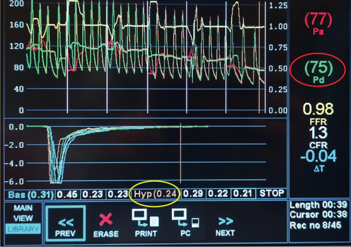Patologická hodnota indexu mikrovaskulární rezistence (IMR = 33)
vypočítaná z hodnoty Pd a Tmn (Hyp) vyznačenými červeně, resp. žlutě