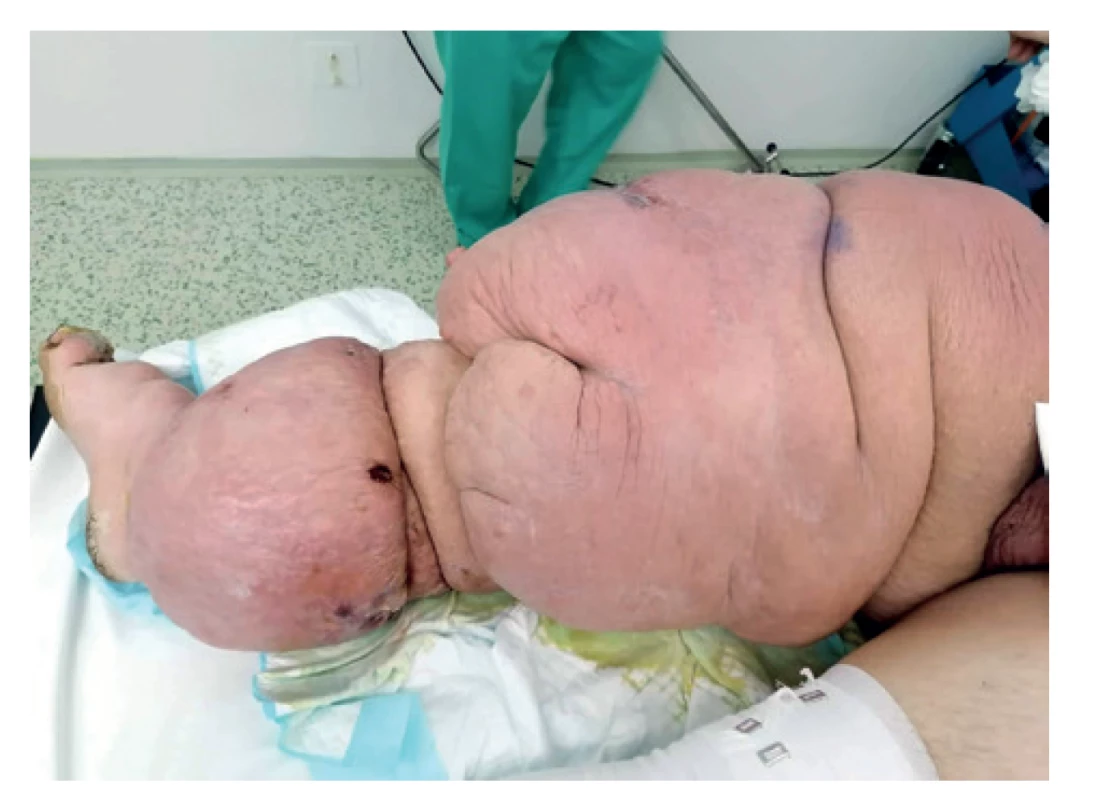 Lymfedém pravej dolnej končatiny pred amputáciou<br>
Fig. 2: Lymphoedema of the right lower limb before amputation