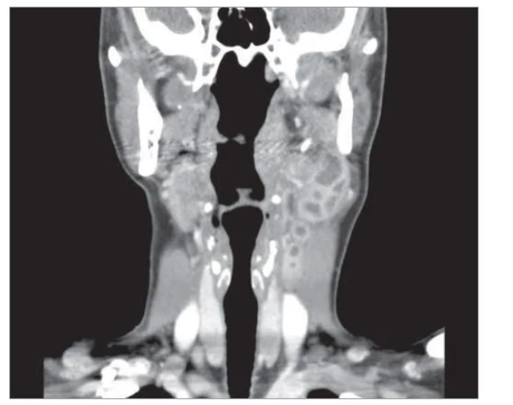 CT krku.<br>
Fig. 2. CT of neck.