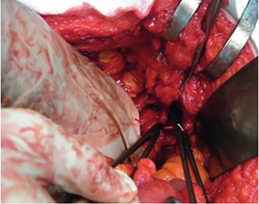 Bránka Petitovej lumbálnej hernie<br>
Fig. 3: Petit´s lumbar hernia gate