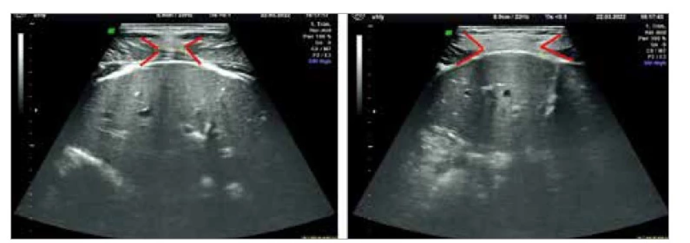 Vyšetrenie diastázy m. rectus abdominis prostredníctvom
2D ultrazvuku – naľavo bez diastázy, napravo s miernou diastázou.<br>
Fig. 1. Examination of diastasis m. rectus abdominis through 2D ultrasound –
without
diastasis on the left, with a slight diastasis on the right.