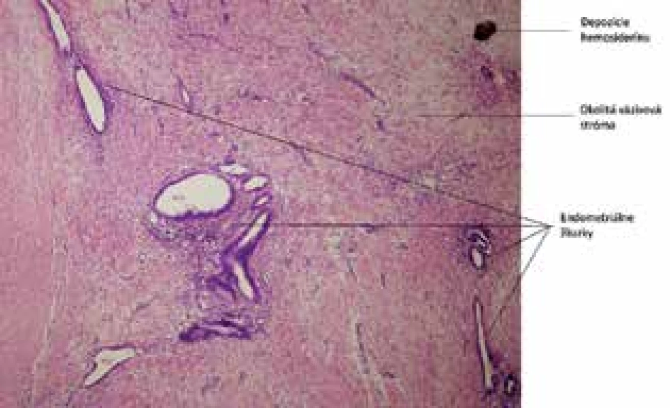 Endometrióza v jazve: prítomné je husté kolagénové väzivo s  prezenciou endometriálnych žliazok. Farbenie Hematoxylín-eozín 40×<br>
Fig. 5: Abdominal wall endometriosis: collagen tissue and 
endometrial glands, HE 40×
