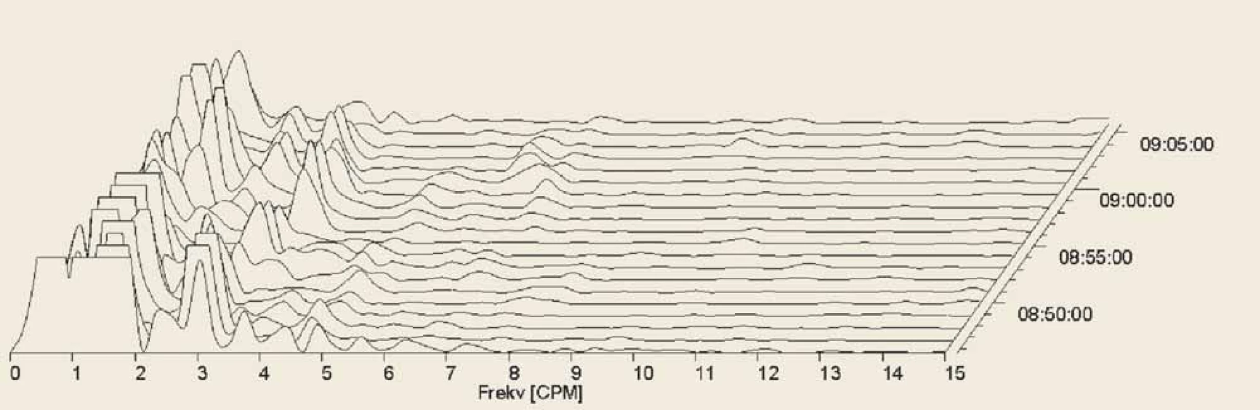 Electrogastrography. Fourier transform. Severe postprandial gastric arrhythmia with predominant bradygastria.<br>
Elektrogastrografie. Fourierova transformace. Těžká postprandiální žaludeční arytmie s převládající bradygastrií.