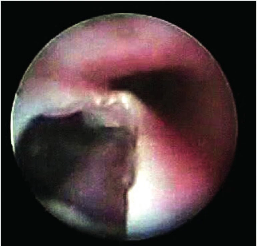 Tracheo-ezofageální píštěl po extrakci diskové baterie.<br><b>Fig. 12.</b> Tracheo-esophageal fistula after disc battery extraction.
