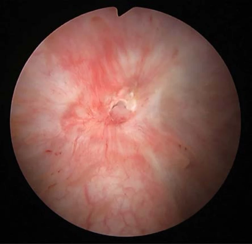 Kontrolní cystoskopický nález osm týdnů po
TUR biopsii<br>
Fig. 4. Control cystoscopy finding 8 weeks after TUR
biopsy