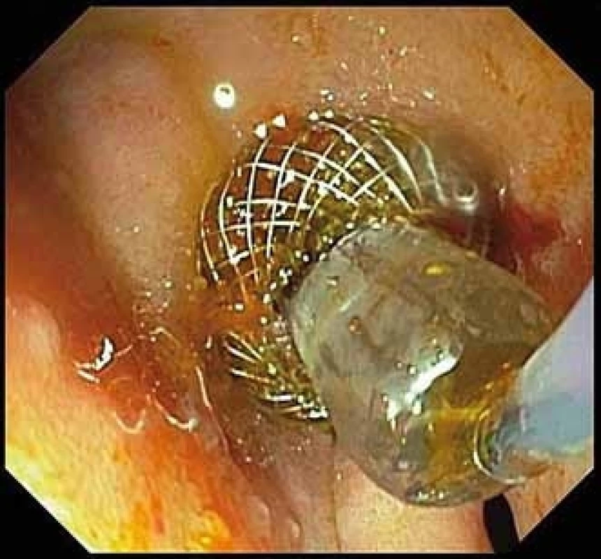 Balonová dilatace stentu.<br>>
Fig. 5. Balloon dilation of the stent.