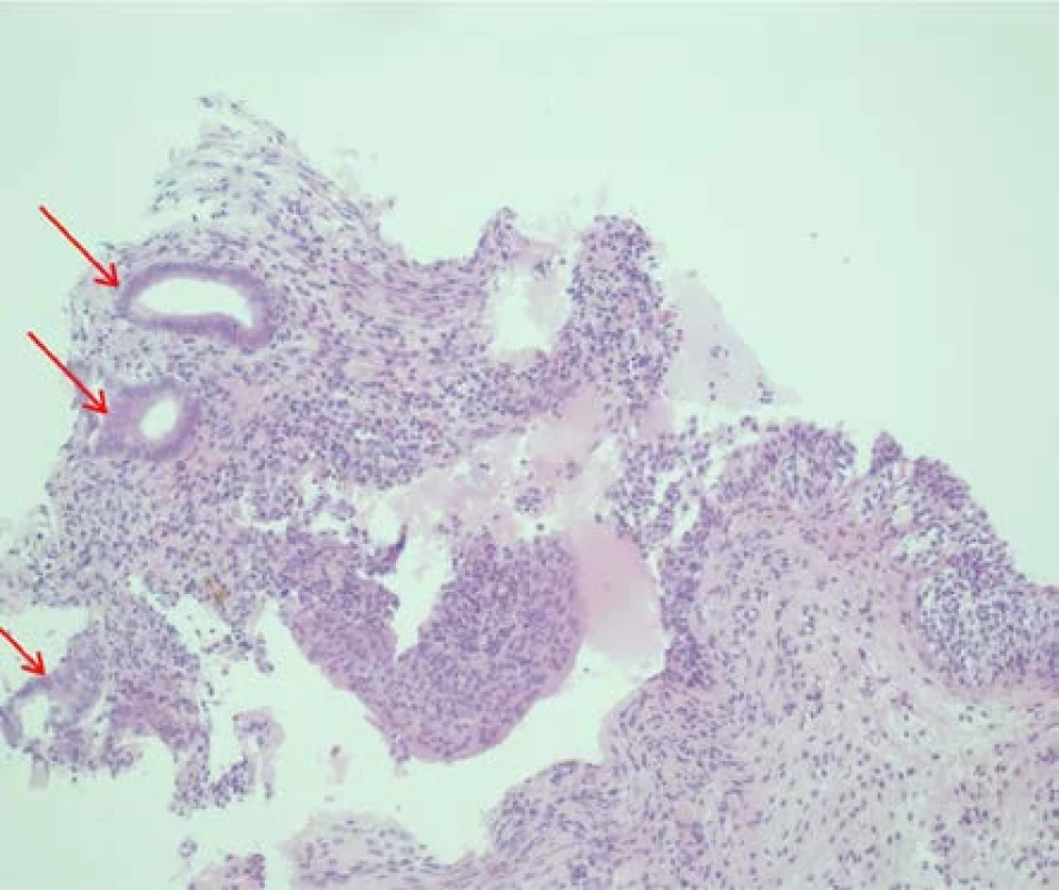 Histologický preparát endometriózy močového
měchýře, hematoxylin-eosin, zvětšeno 200×, šipky
ukazují žlázky endometria (fotografie poskytnul MUDr.
Jan Nožička Ph.D.)<br>
Fig. 6. Histological specimen of endometriosis of
the bladder, hematoxylin-eosin, magnification 200×,
arrows show endometrial glands (photos provided by
Jan Nožička M.D., Ph.D.)