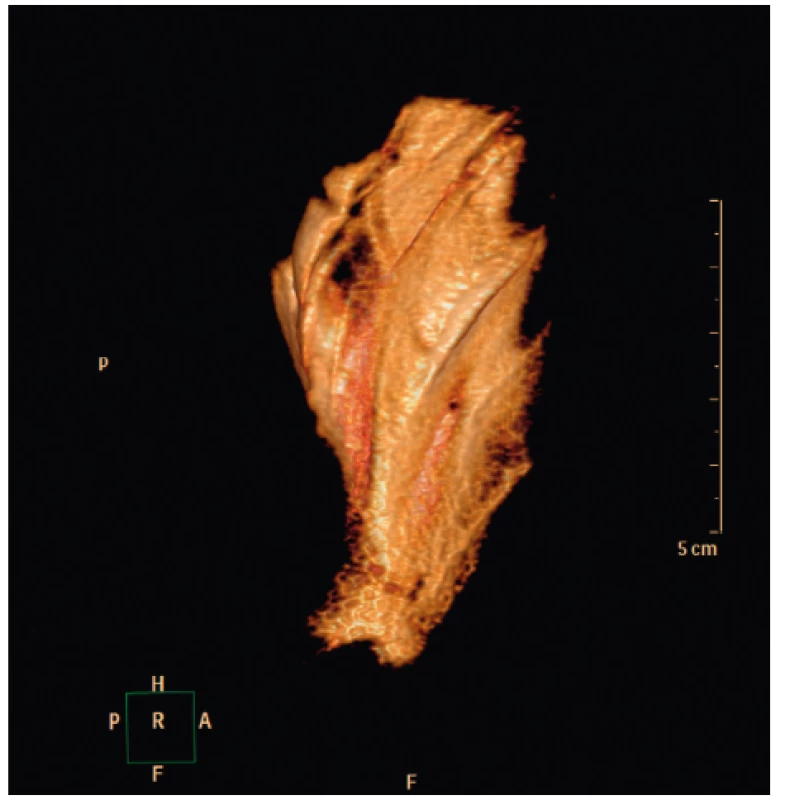 3D rekonstrukce tekutinové náplně prostoru mezi
m. levator scapulae a skupinou erektorů