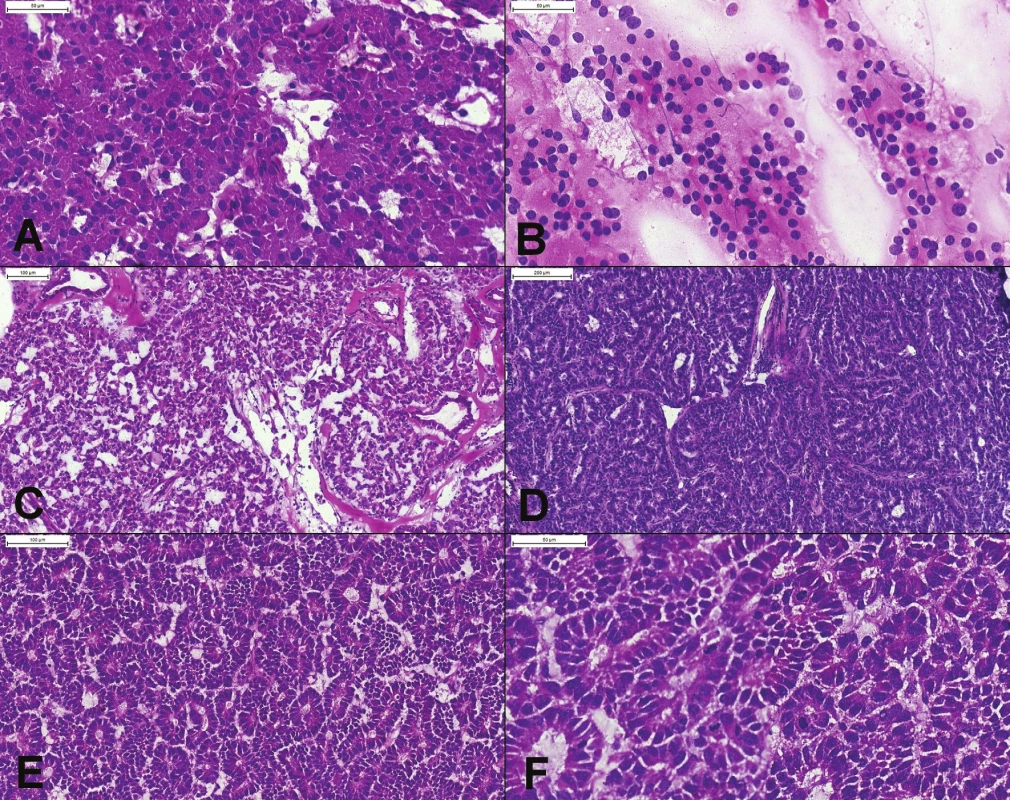 (A) Prevažne solídne rastúci dobre diferencovaný neuroendokrinný tumor, tvorený bunkami s eozinofilnou cytoplazmou,
uniformnými okrúhlymi excentricky umiestnenými jadrami, bez mitóz. (B) Peroperačný cytologický náter potvrdzujúci diagnózu
– diskohezívna populácia blandných plazmocytoidných buniek s blandným chromatínom, bez nápadnejších jadierok. (C, D)
Pseudoglandulárne, trabekulárne a acinárne usporiadanie niektorých NET-ov môže spôsobiť diagnostické ťažkosti. Podobnú architektoniku
môže mať acinárny karcinóm. (E) Acinárny karcinóm pankreasu. Tumor má difúzne acinárne usporiadanie, s bazálne
lokalizovanými jadrami. (F) Výrazná mitotická aktivita (6 mitóz v jednom poli) je v dobre diferencovaných NET-och vzácna. Prominentné
jadierka typické pre acinárny karcinóm v zmrazenom reze neboli dobre viditeľné.