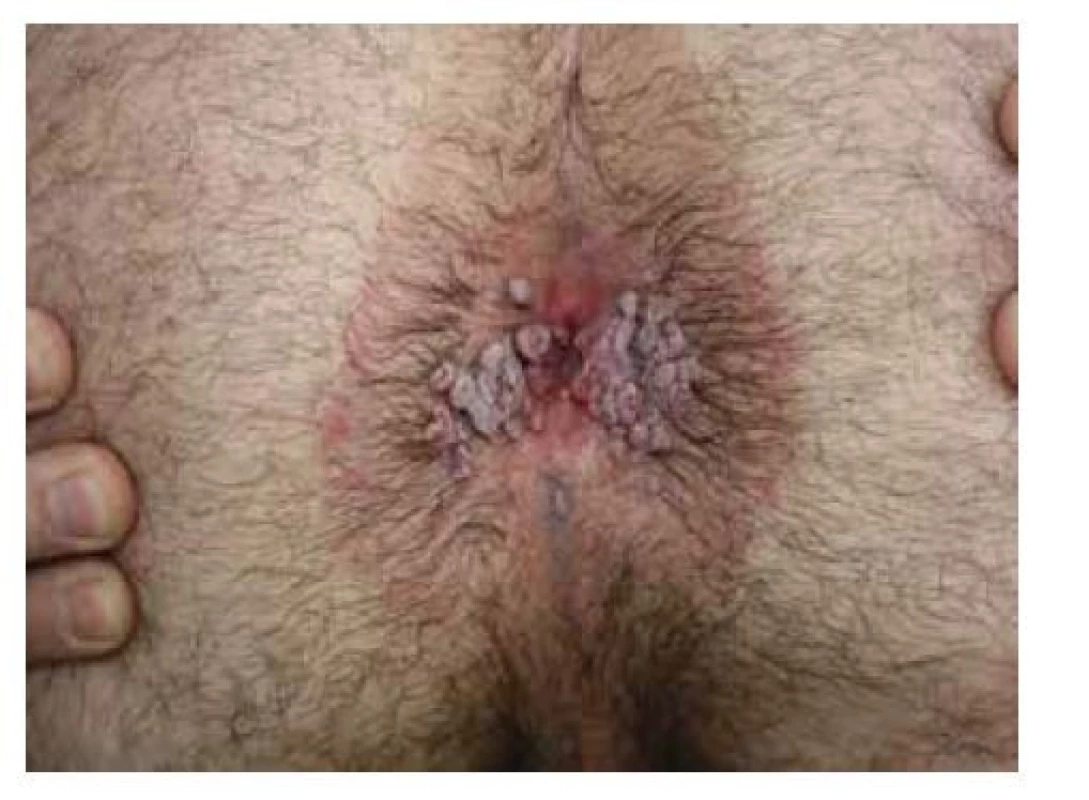 Perianální condylomata lata<br>
(archiv Dermatovenerologické kliniky 2. LF UK a FN Bulovka)