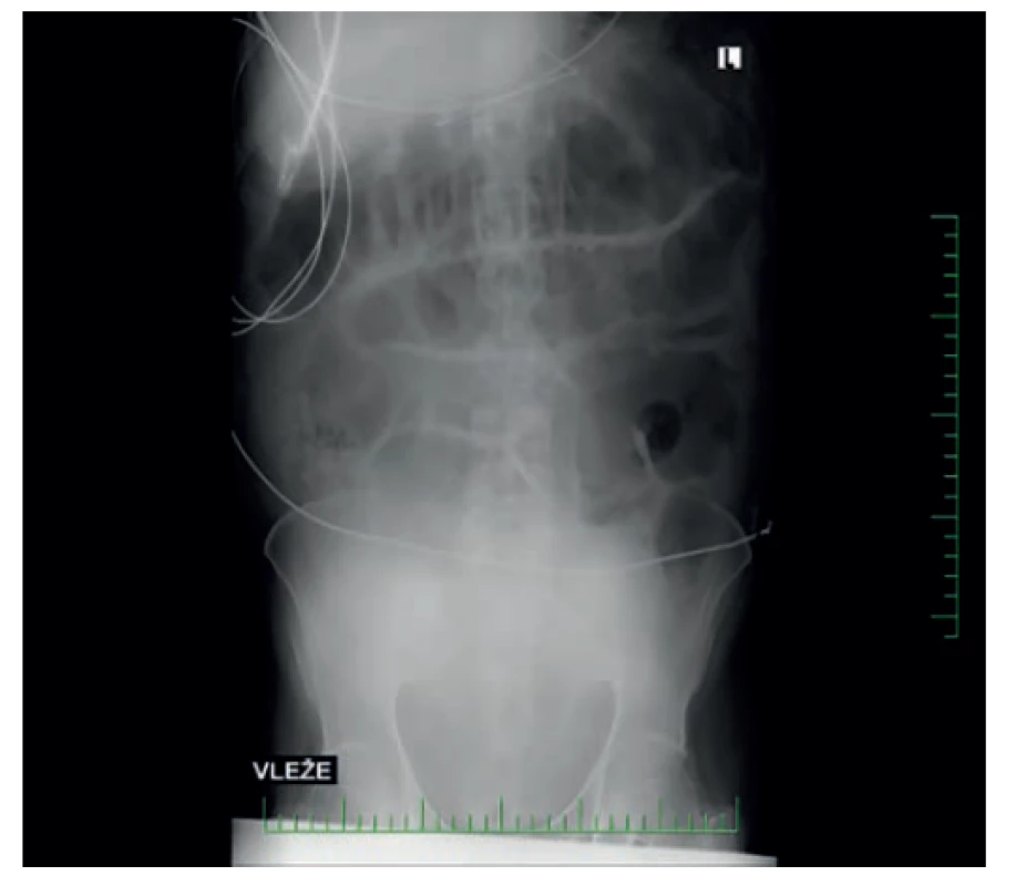 RTG břicha druhý den po přijetí<br>
Fig. 2: Abdominal X-ray – second day after admission