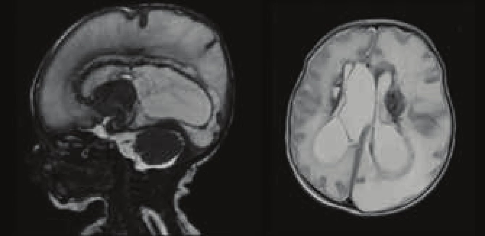 MRI vyšetření CNS – rozsáhlé ischemicko-pseudocystické
změny obou mozkových hemisfér, slupkovitý parenchym vlevo
a oboustranně zjevné periventrikulární krvácení.