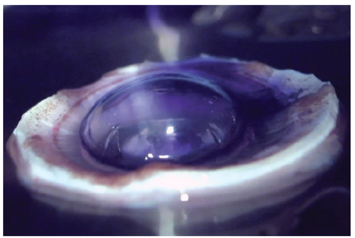 Convex DM separation by liquid bubble. Air bubble
and trypan blue for staining of DM