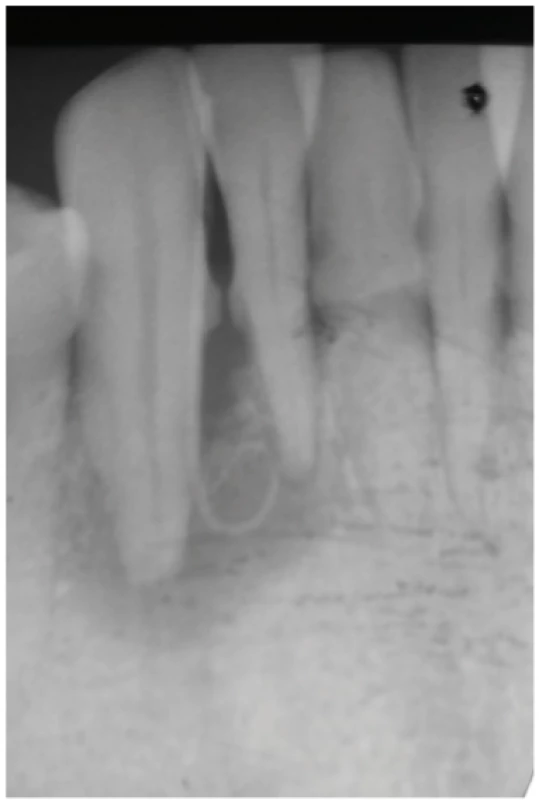 Periapical radiograph of tooth 43
