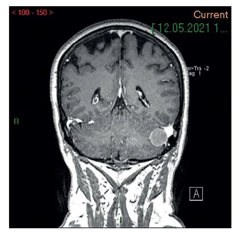 Kontrastné MRI vyšetrenie mozgu<br>
Nález tumorov/pseudotumorov infratentoriálne vs meningeómy
(koronárny rez).<br>
Fig 5: Contrast enhanced brain MRI<br>
Shows infratentorial tumors/pseudotumors – meningiomas
(coronal view).