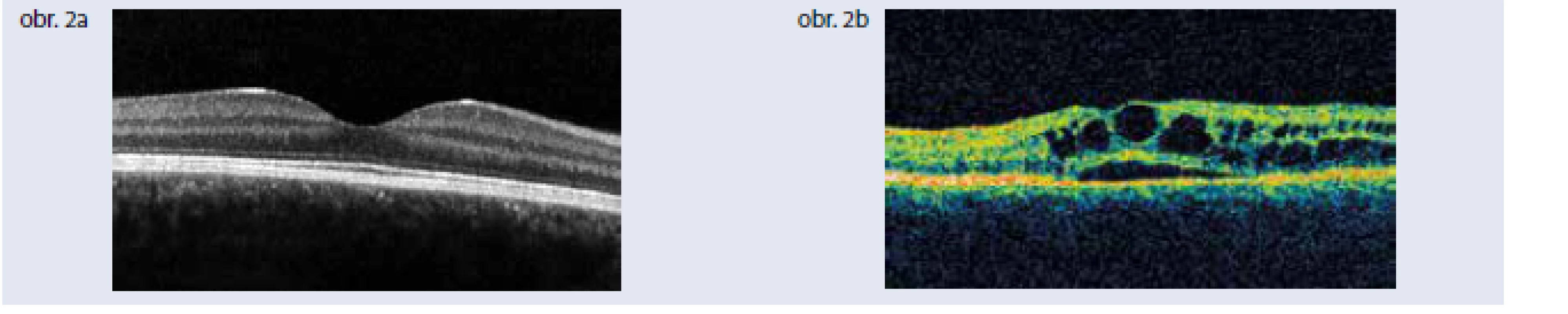 Optická koherentná tomografia. Obr. 2a | Optická koherentná tomografia normálnej makuly
Obr. 2b | Optická koherentná tomografia diabetického cystoidného edému makuly. Archív autorky