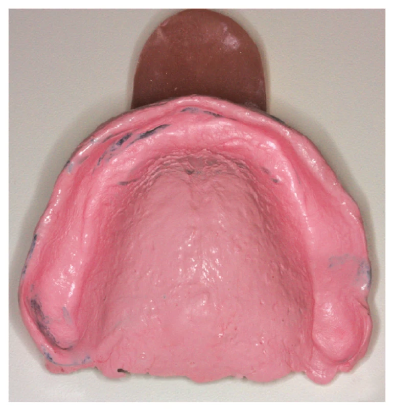 Sekundární
a funkční otisk
v individuální lžíci<br>
Fig. 1
Secondary
and functional impression
in individual impression tray