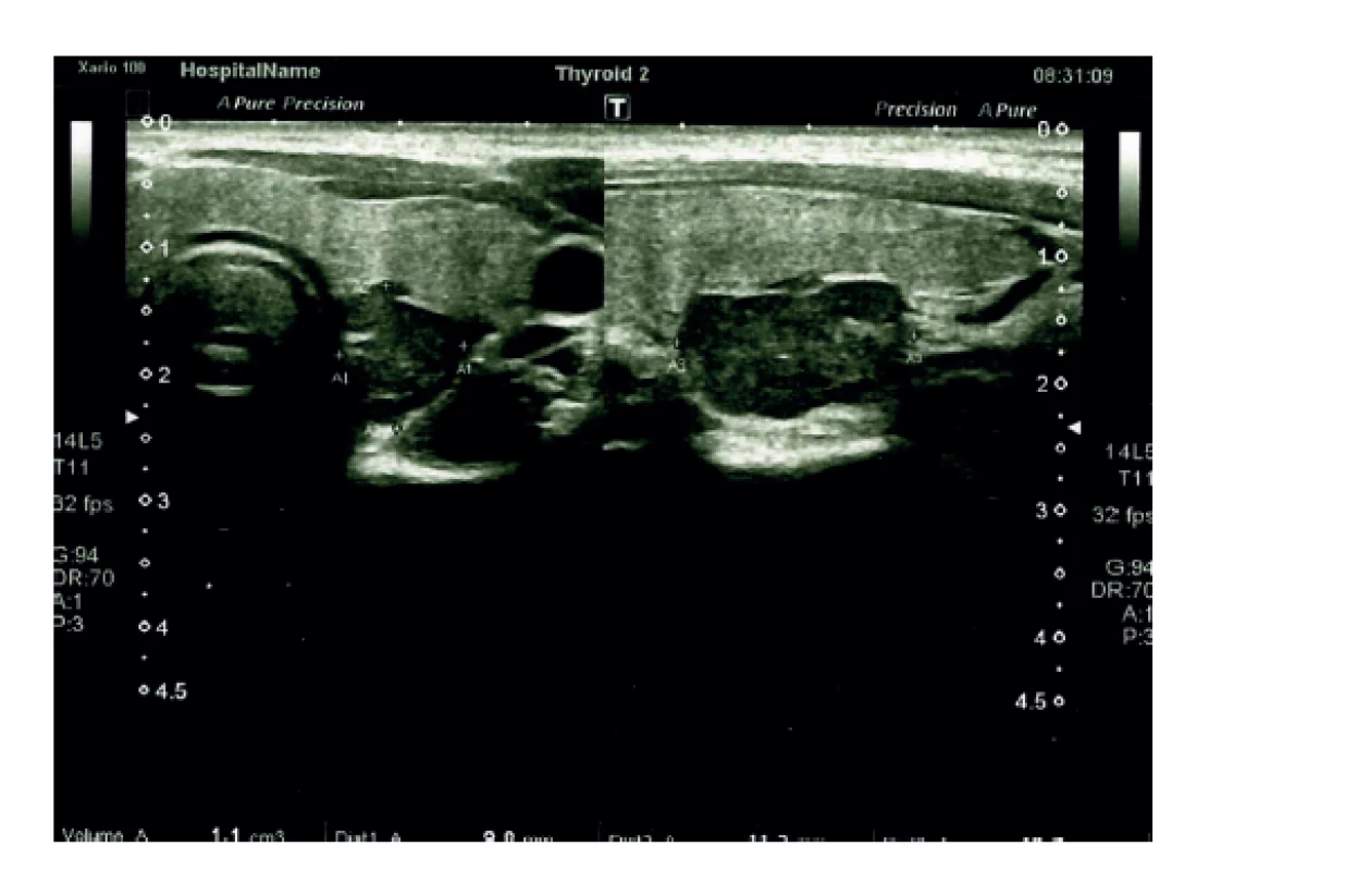 Předoperační ultrasonografický nález zachycuje
hypoechogenní ložisko za levým lalokem štítné žlázy<br>
(Z osobního archivu profesora Astla)<br>
Fig. 1: Preoperative ultrasonography capturing the hypoechoic
lesion behind the left lobe of the thyroid gland<br>
(From Prof. Astl´s personal archive)