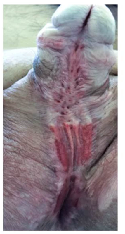 Uretrální ploténka šest měsíců
po dermatologické léčbě<br>
Fig. 4. Urethral plate six months
after dermatological treatment