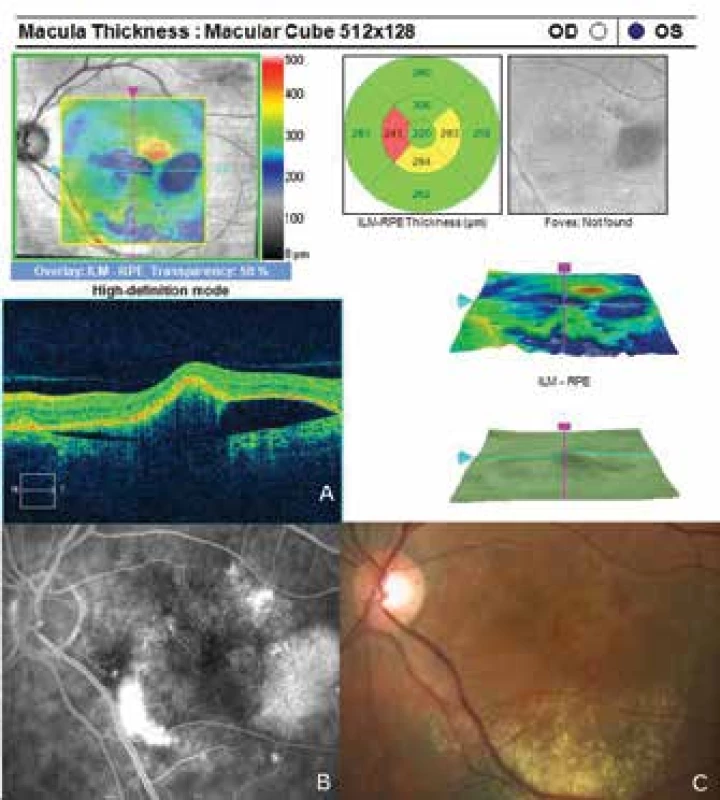 Improvement of condition of left eye following commencement
of anti-VEGF treatment