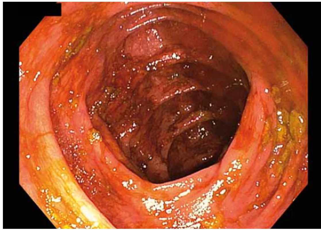 Kvalita střevní přípravy dle BBPS – hodnocení
1 bod.<br>
Fig. 3. Quality of intestinal preparation according to BBPS –
1 point.<br>
BBPS – Boston Bowel Preparation Scale