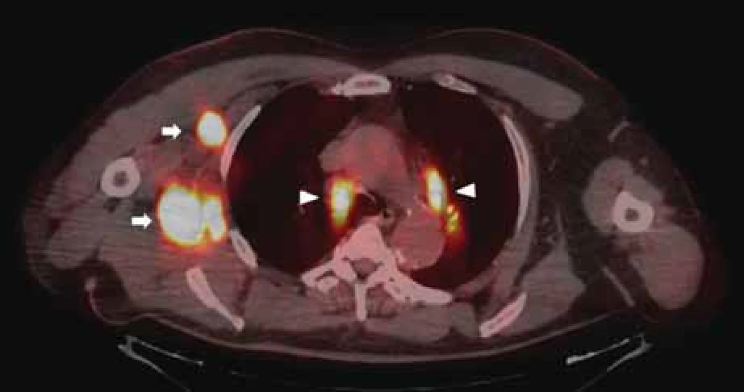 Kontrolní PET/CT vyšetření ze srpna 2019. Šipky značí relaps nádorového onemocnění v oblasti pravé axily, plic a mediastina.
