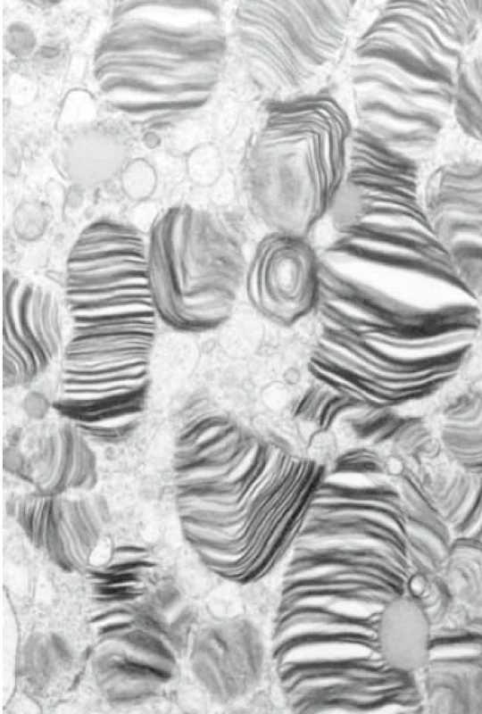 Elektronová mikroskopie –
nález střádání v lysozomech, obraz
typický pro Anderson-Fabryho chorobu,
„zebra like bodies”. (Fotografie
prof. Elleder, Ústav dědičných metabolických
poruch 1. LF UK, Praha.)<br>
Fig. 3. Electron microscopy – finding of
accumulation in lysosomes, image typical
for Anderson-Fabry disease, „zebra
like bodies“. (Photo Prof. Elleder, Institute
of Inherited Metabolic Disorders,
1st Faculty of Medicine, Charles University,
Prague.)