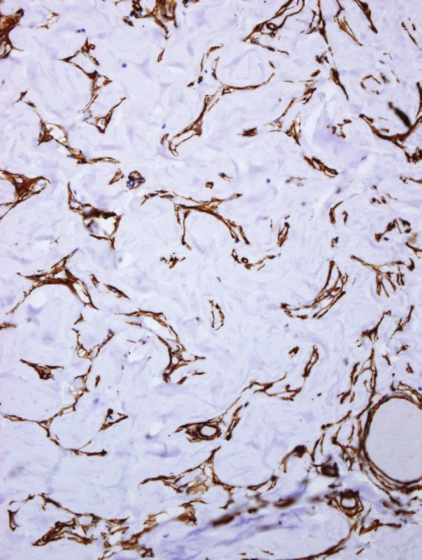 CD34 stain decorates cells lining the pseudovascular spaces as well as
single spindle stromal cells. Delicate bridges between the cells lining spaces can
be observed (original magnification x200).