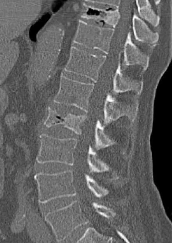 Vyšetrenie zobrazovacími metódami:
CT-zobrazenie osteoporotické kompresívne
fraktúry. Archív Onkologického ústavu
sv. Alžbety, s.r.o., Bratislava
