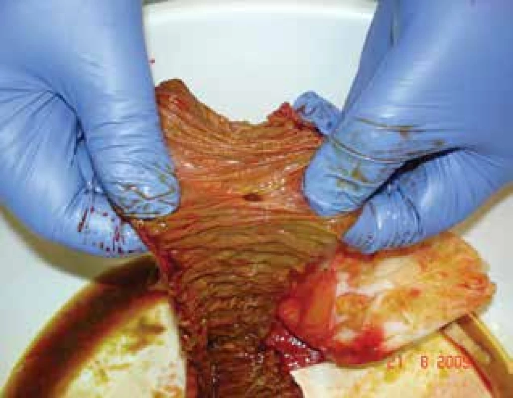 Vstup do divertiklu<br>
Fig. 3: Entry of the diverticulum