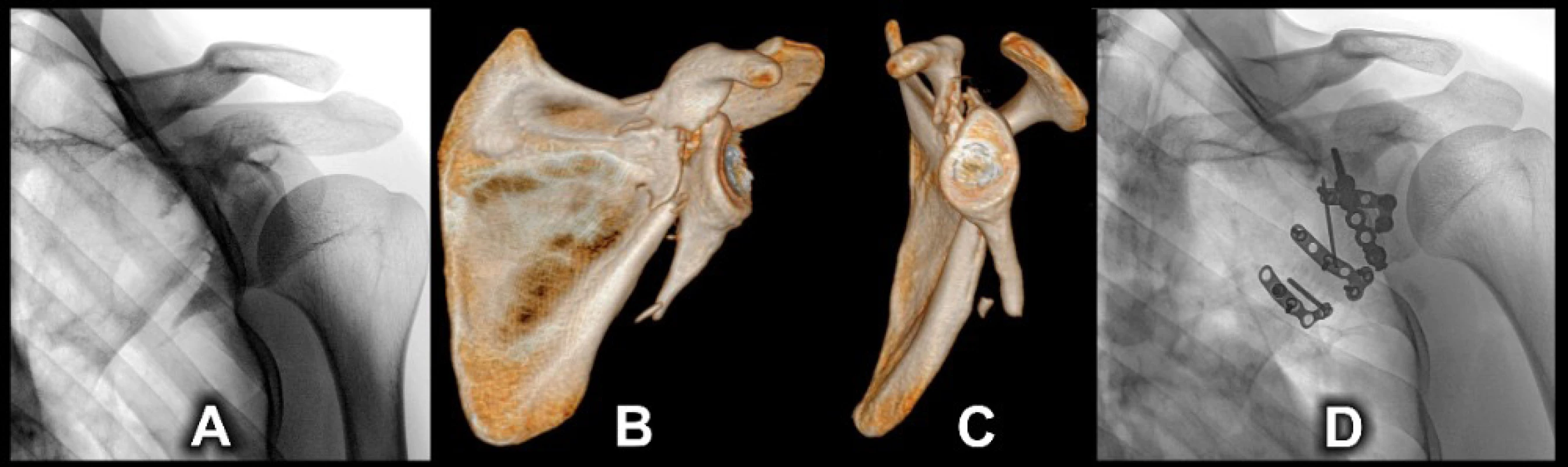  A – preoperative radiograph; B+C – 3D CT reconstructions, anterior and lateral views; D – radiograph one year after
surgery