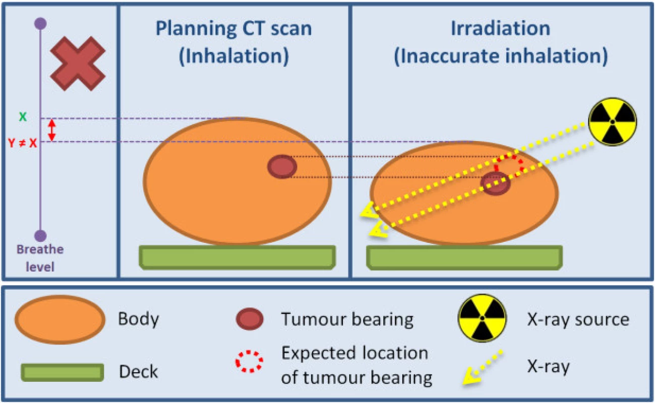 Irradiation process without breathing control.