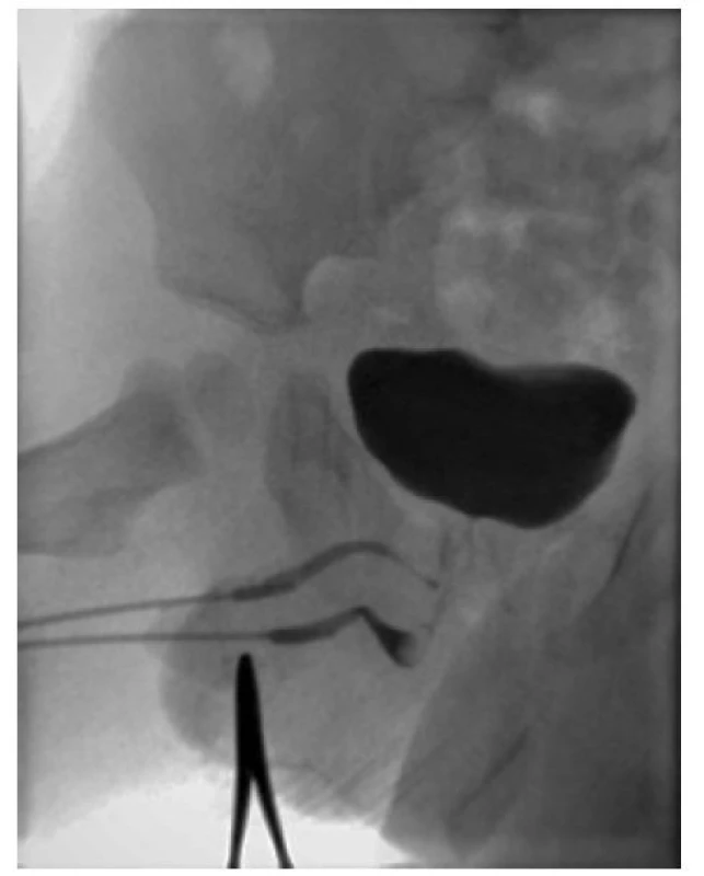 Rentgenové zobrazení nativní a nadpočetné
uretry u chlapce se zdvojením typu Effmann II A1<br>
Fig. 2. Radiographic image of the orthotopic and
an accessory urethra in a boy with an Effmann type
II A1 duplication