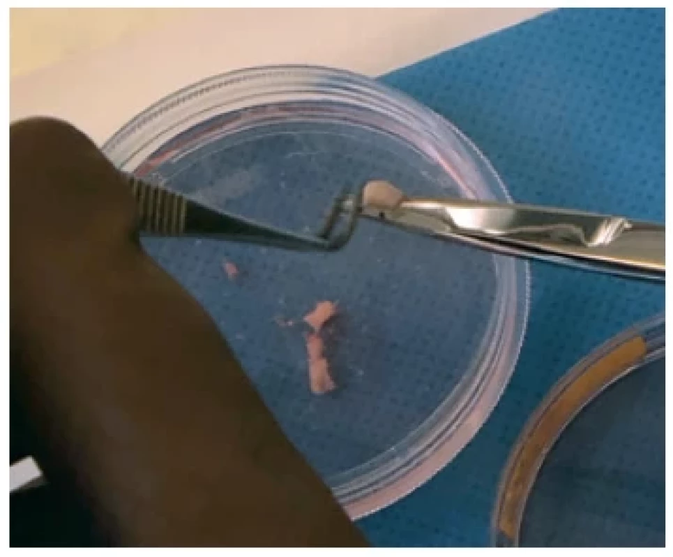Size of tumour before implantation