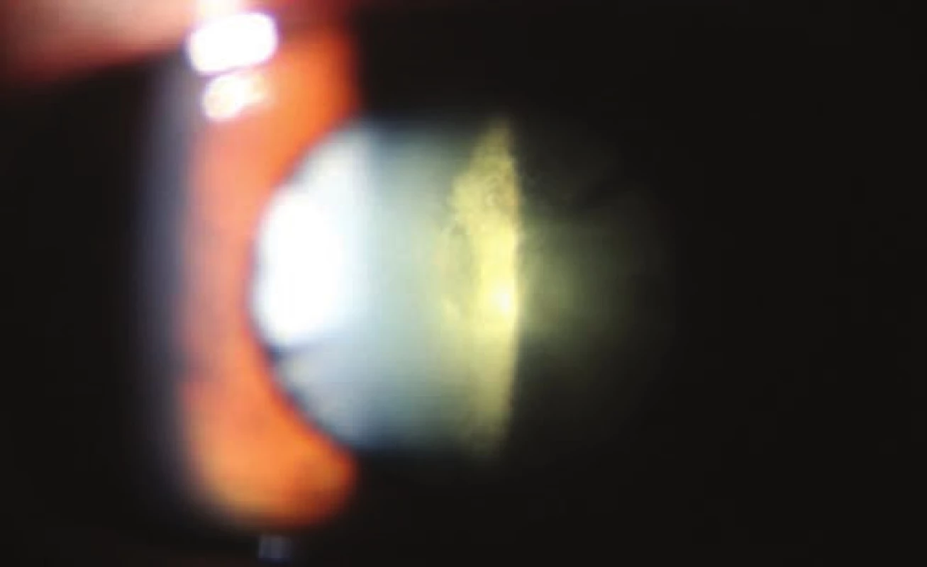 Image of 3rd grade posterior subcapsular cataract according
to Crews