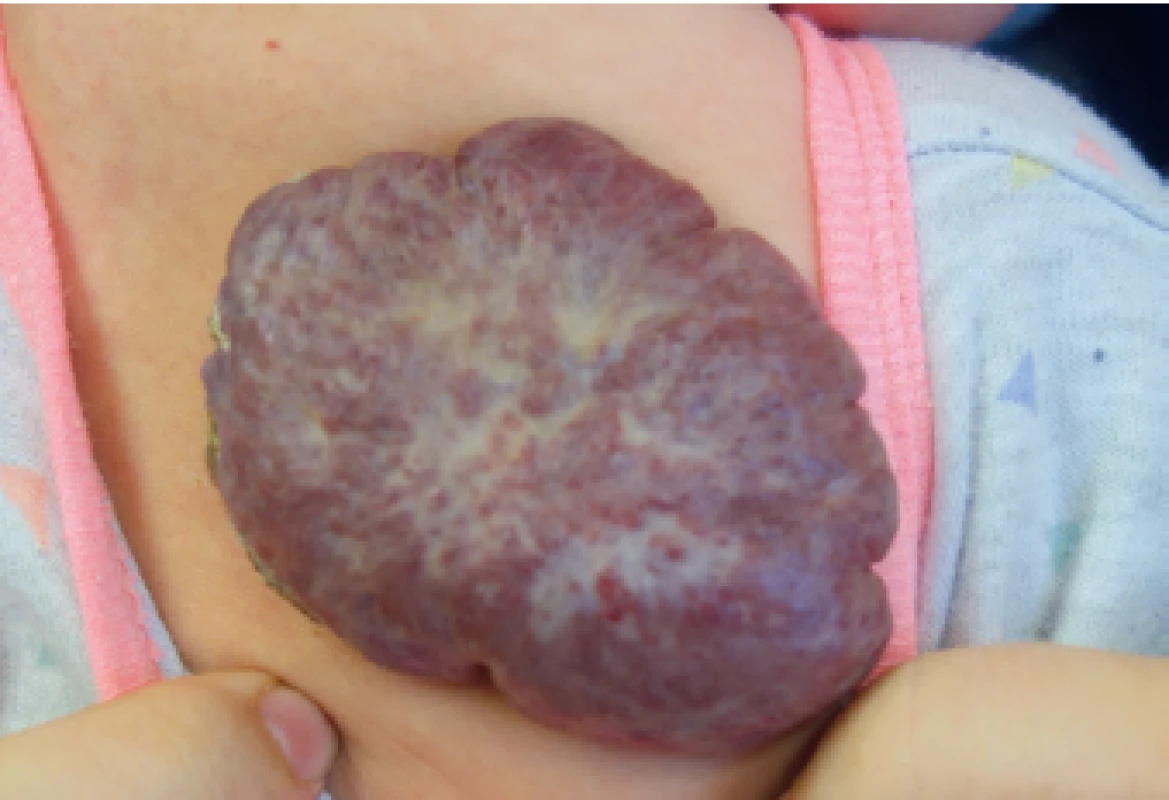 Reziduum plastického neléčeného IH (věk 9 měsíců).<br>
Raised untreated IH residuum (age of 9 months).