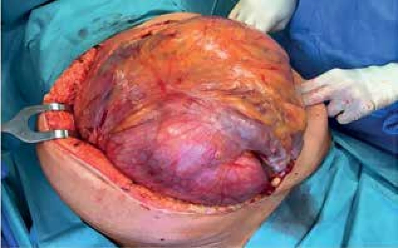 Peroperační nález I (uterinní Müllerianský leiomyom)<br>
Fig. 5: Peroperative finding I (uterine Müllerian leiomyoma)
