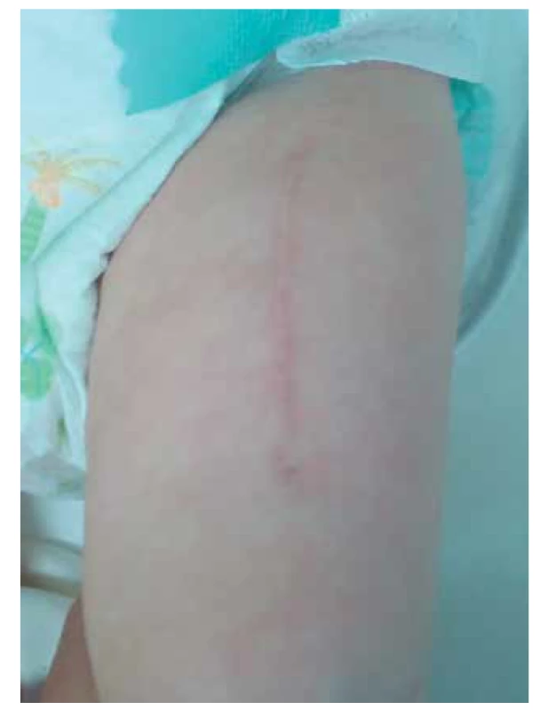 Jizva po implantaci thymu do stehenního svalu.<br>
Fig. 2. Scar after implantation of thymic stroma into the
femoral muscle.