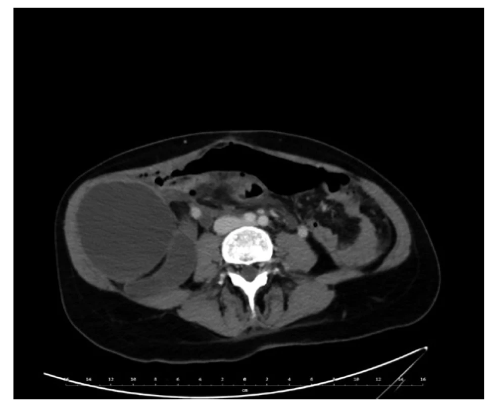 CT břicha, axiální řez. <br>
Bilokulární expanze v pravém retroperitoneu. <br>
Fig. 2: Abdominal CT, axial view. <br>
Bilocular expansion in the right retroperitoneum.