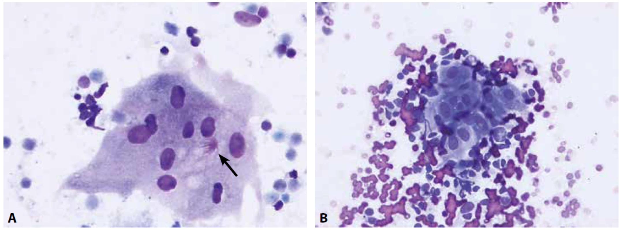 Granulomatózní proces je cytologicky charakterizovaný nálezem epiteloidních buněk a případně buněk obrovských mnohojaderných.<br>
A – obrovská mnohojaderná buňka s asteroidní inkluzí (šipka) u pacienta se sarkoidózou (nátěr z EBUS-FNA nitrohrudní lymfatické uzliny, Diff-Quik®, 400x)<br>
B – epiteloidní buňky, vyskytující se ve shlucích mezi buňkami uzliny, mají protáhlý tvar jader, jemný chromatin a bohatou, nezřetelně ohraničenou cytoplazmu
(nátěr z EBUS-FNA lymfatické uzliny u pacienta se sarkoidózou; Diff-Quik®, 400x)
