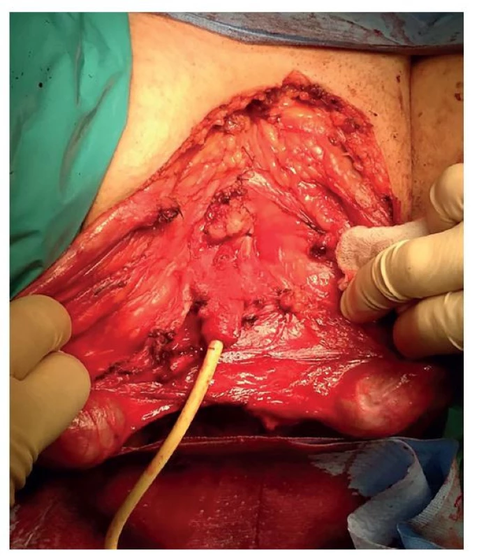 Peroperační nález po amputaci penisu, ponechán
pahýl uretry<br>
Fig. 2: Peroperative finding after penile amputation;
urethral stump