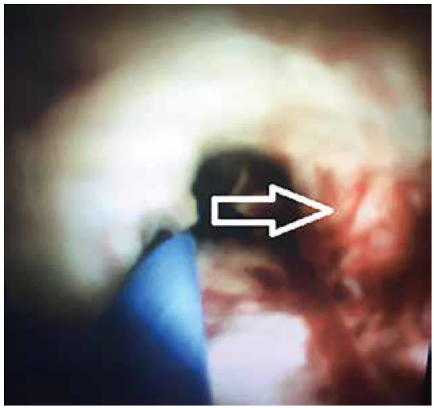 Cholangioskopie – ulcerující typ tumoru s patologickou
vaskularizací. Označeno šipkou.<br>
Fig. 4. Cholangioscopy – ulcerous type of tumour with
pathological vascularisation. Marked with the arrow