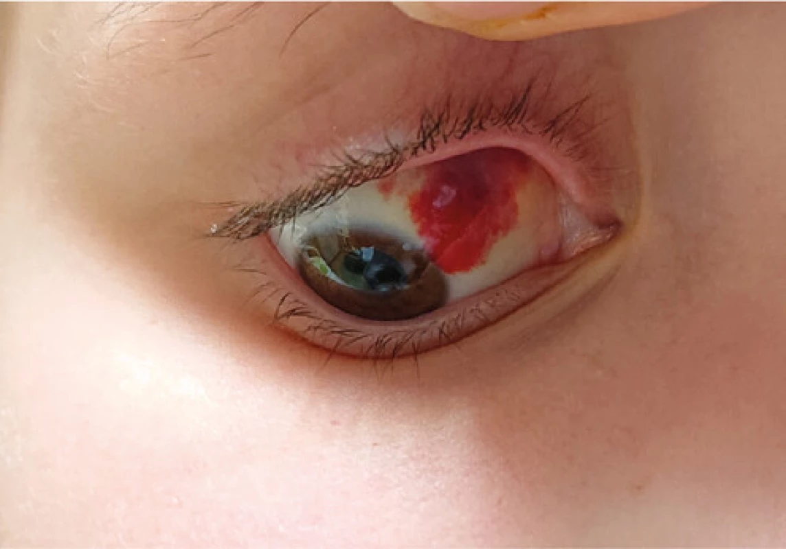 Změny na spojivce při PIMS-TS (pediatric inflammatory multisystem 
syndrome temporally associated with covid-19)