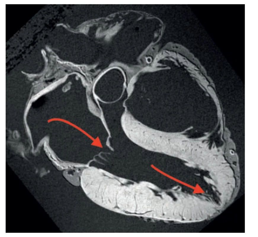 Hypotetická cesta migrácie katétra z pravej komory
cez apex pravej komory<br>
Fig. 6. Hypothetical route of migration of the catheter
from right ventricle through the apex of the right ventricle