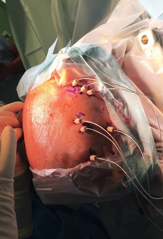 Intracerebrální EEG elektrody krátce po implantaci
(11letá pacientka s farmakorezistentní epilepsií pravého
frontálního laloku na podkladě FCD II. typu).<br>
Fig. 2. The intracerebral (depth) EEG electrodes shortly after
implantation (11-y old girl with refractory right-sided
frontal-lobe epilepsy conditioned by FCD II).