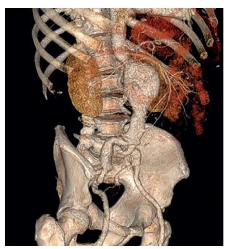 CT rekonstrukce AAA<br>
Fig. 1: AAA CT reconstruction