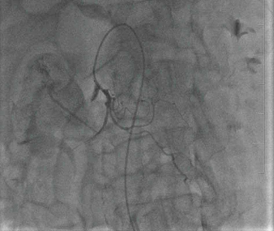 Angiografie – únik kontrastní látky do dutiny pankreatické
pseudocysty.
Fig. 2. Angiography – leakage of contrast medium into the
pancreatic pseudocyst cavity.