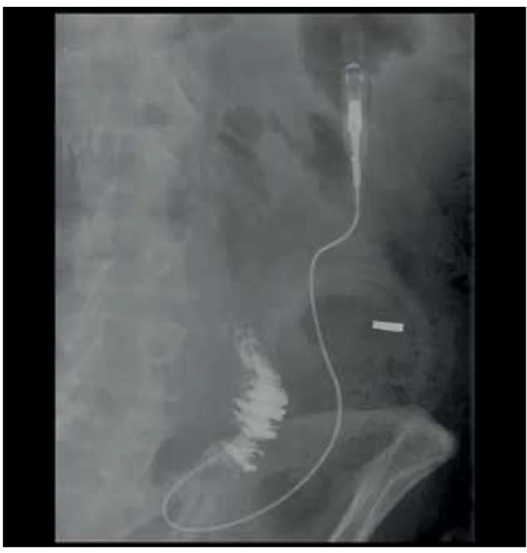 Nově zavedený delší jejunostomický katetr (místo
píštěle označeno kontrastně)<br>
Fig. 3. Newly inserted longer jejunostomal catheter (fistula
position marked with contrast agent)